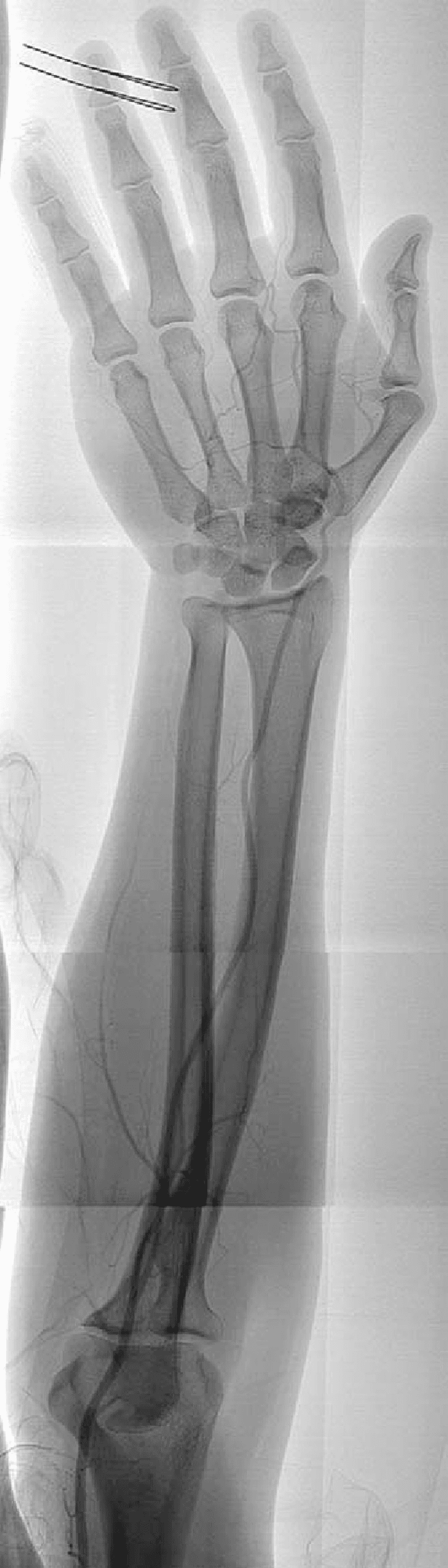 **Imaging Modality:** Digital Subtraction Angiography (DSA) / Arteriography.

**Anatomical Region:** Left forearm and hand.

**Observed Pathology:** Arteriogram demonstrating significant vascular anomalies of the distal upper extremity. The ulnar artery appears atretic, failing to provide significant contribution to the palmar circulation. The deep palmar arch shows filling predominantly via the radial artery, indicating a lack of normal dual arterial supply.

**Characteristic Visual Features:**
- **Atretic Ulnar Artery:** Absence or severe hypoplasia of the ulnar artery as it approaches the wrist and hand.
- **Palmar Arch Hypoplasia:** The palmar arches are hypoplastic, particularly on the ulnar side.
- **Digital Artery Compromise:** The 4th and 5th digital arteries originate from a diminutive deep palmar arch, exhibiting markedly reduced contrast opacification and poor distal blood flow compared to the radial-side digits.
- **Collateralization:** Visual evidence of compensatory filling of the deep arch from the radial system.

**Key Diagnostic Features:** Congenital or acquired ulnar artery atresia resulting in an incomplete palmar arch and distal digital ischemia of the ulnar-sided phalanges. Relevant for surgical planning and evaluation of peripheral vascular disease.