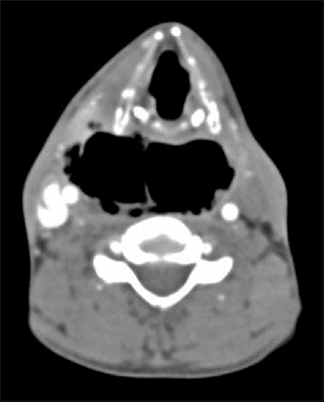 **Modality:** Axial Computed Tomography (CT) of the neck with contrast.

**Anatomic Region:** Deep neck spaces at the level of the hypopharynx and cervical vertebrae.

**Pathology:** Extensive emphysema/gas collection within the retropharyngeal and "danger" spaces.

**Visual Features:**
- **Distribution:** Large, confluent pockets of low-attenuation gas (black) occupy the retropharyngeal space. 
- **Landmarks:** The gas collection is positioned posterior to the pharyngeal constrictor muscles and anterior to the prevertebral fascia.
- **Extension:** The gas extends across the midline, indicating potential involvement of the "danger space" (the potential space between the alar and prevertebral fascia).
- **Secondary Findings:** There is visible soft tissue swelling and displacement of adjacent vascular and airway structures. Scattered small gas bubbles are also visible in the right lateral soft tissues.

**Diagnostic Significance:** This radiologic pattern is characteristic of a deep neck space infection (e.g., retropharyngeal abscess with gas-forming organisms) or traumatic pneumomediastinum/neck emphysema. Cross-midline extension in this anatomical plane is a key feature for identifying potential pathways for descending mediastinitis.