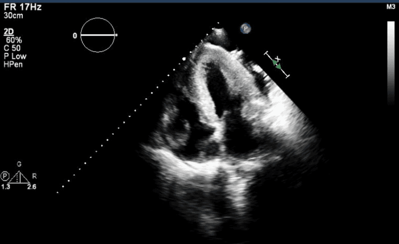 **Imaging Modality:** Transthoracic Echocardiogram (TTE), 2D grayscale.

**Anatomical View:** Apical four-chamber (A4C) view.

**Observed Pathology:** The image demonstrates severe concentric biventricular hypertrophy. There is marked, symmetrical thickening of the left ventricular (LV) walls, including the interventricular septum and the lateral wall, leading to a significantly reduced LV cavity size. Parallel thickening is also noted in the right ventricular (RV) free wall, indicating global myocardial involvement.

**Characteristic Visual Features:**
*   **Myocardial Texture:** The myocardium exhibits an increased echogenicity with a "speckled" or granular appearance, often associated with infiltrative cardiomyopathies such as cardiac amyloidosis.
*   **Chamber Morphology:** Both ventricles appear small and restrictive. Both the left and right atria appear relatively dilated compared to the thickened ventricles.
*   **Valve Morphology:** The atrioventricular valves (mitral and tricuspid) are visible, with the mitral valve leaflets appearing slightly thickened.

**Diagnostic Significance:** These findings are characteristic of severe restrictive or infiltrative cardiomyopathy. The combination of concentric biventricular wall thickening and biatrial enlargement are key diagnostic markers for advanced hypertrophic or infiltrative disease processes.