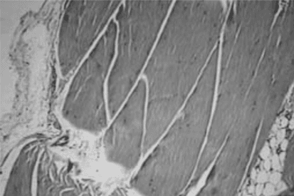 **Imaging Modality:** Histopathology (Light microscopy)  
**Stain:** Hematoxylin and Eosin (H&E)  
**Magnification:** 40x  
**Anatomical Region:** Tendon tissue  

**Description:**  
The micrograph displays a longitudinal section of dense regular connective tissue characteristic of a healthy tendon. The primary architectural feature is the parallel arrangement of eosinophilic type I collagen fiber bundles (fascicles). Interspersed between these bundles are elongated, flattened nuclei of tenocytes (fibrocytes), oriented parallel to the long axis of the collagen fibers. 

**Key Visual Features:**  
- **Fascicular Organization:** Distinct primary fiber bundles are visible, separated by thin endotenon layers.  
- **Cellularity:** Low cellular density with quiescent tenocytes exhibiting spindle-shaped morphology.  
- **Extracellular Matrix:** Dense, wavy (crimped) eosinophilic matrix indicating mechanical integrity.  
- **Associated Tissue:** Minimal peripheral loose connective tissue and adipocytes are visible at the margin, likely representing the paratenon or epitenon interface.  

**Diagnostic Relevance:**  
The image serves as a reference for normal tendon histology, showing absence of neovascularization, mucoid degeneration, or inflammatory infiltration, which are key markers for tendinopathy or chronic injury.