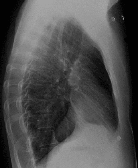 **Imaging Modality:** Lateral Chest Radiograph (X-ray).

**Anatomical Region:** Thoracic cavity, including the mediastinum, lungs, and diaphragm.

**Observed Pathology and Visual Features:**
The image demonstrates signs of pulmonary hyperinflation. Key radiologic features include:
*   **Anterior Clear Space:** There is a notable increase in the retrosternal clear space (the lucent area between the posterior aspect of the sternum and the anterior wall of the ascending aorta), suggesting an increase in lung volume.
*   **Thoracic Configuration:** The anteroposterior (AP) diameter of the chest is increased, contributing to a "barrel chest" appearance. 
*   **Diaphragmatic Appearance:** The hemidiaphragms appear flattened rather than normally domed.
*   **Lung Parenchyma:** Increased radiolucency is observed throughout the lung fields, consistent with air trapping.

**Clinical Context:**
These findings are classic radiographic markers for Chronic Obstructive Pulmonary Disease (COPD), specifically emphysema. 

**Key Diagnostic Features:**
The combination of an enlarged retrosternal clear space (typically $>2.5$ cm), flattened diaphragms, and an increased AP diameter on a lateral projection are the primary diagnostic cues for identifying chronic lung hyperinflation.