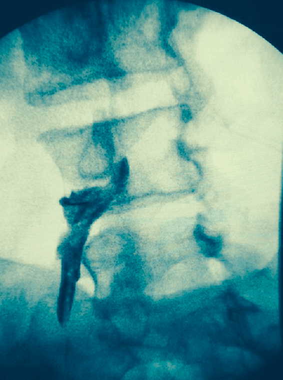 **Imaging Modality:** Fluoroscopy (Spot film)

**Anatomical Region:** Lumbar spine, oblique view.

**Procedure/Intervention:** Fluoroscopically guided transforaminal epidural injection (transforaminal nerve block). 

**Characteristic Visual Features:**
- **Needle Placement:** A radiopaque spinal needle is visualized with its tip positioned within the neural foramen, typically at the "6 o'clock" position of the pedicle in an oblique projection.
- **Contrast Pattern:** A radiopaque contrast medium (epidurogram) is seen delineating the targeted nerve root sheath. The flow pattern demonstrates characteristic spread along the spinal nerve within the neuroforamen and extending into the lateral epidural space.
- **Landmarks:** Distinct visualization of the vertebral bodies, pedicles ("scotty dog" appearance), and the intervertebral foramen.

**Clinical Context:** This image demonstrates a diagnostic and therapeutic interventional procedure used to treat radicular pain. The contrast spread confirms the correct anatomical localization of the needle tip and ensures the medication will reach the ventral epidural space while avoiding intravascular or intrathecal injection.

**Key Diagnostic Features:** Linear contrast opacification along the course of the lumbar nerve root exiting the foramen.