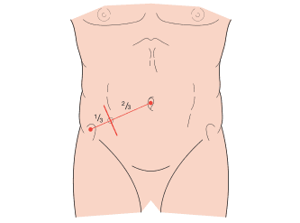 Bailey and Love's Short Practice of Surgery 28th Edition
