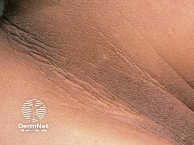 Imaging modality and technique: High-resolution clinical photograph of the neck with close-up frontal/anterolateral view, non-dermoscopic, natural lighting. Anatomical location: Cervical skin folds in the neck (anterior/lateral neck) with intertriginous distribution. Visual features: Velvety, hyperpigmented plaques extending along the lateral neck folds and base of the neck; smooth to slightly coarse surface; skin appears thickened with subtle linear furrowing and reduced elasticity; color ranges from dark brown to slate-brown; edges are well defined where patches meet normal skin. Pathology: In clinical context, consistent with acanthosis nigricans; underlying epidermal hyperplasia and papillomatosis are recognized histologically, though not shown in this image. Diagnostic relevance: sign of insulin resistance/metabolic syndrome and obesity; could reflect type 2 diabetes risk; in older patients or rapidly progressive, raise concern for malignant acanthosis nigricans associated with gastrointestinal cancers. Differential diagnoses include frictional hyperpigmentation, other dermatoses causing darkening in flexures. Clinical use cases: dermatology and endocrinology assessment, metabolic screening, monitoring response to weight loss or diabetes treatment, education for patients about skin changes and associated systemic risk. This image serves as a visual teaching example of classic neck involvement in acanthosis nigricans, highlighting morphology, distribution, and clinical significance for medical students and clinicians.
