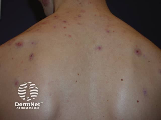 Imaging modality and technique: Clinical photography in color, dorsal posterior trunk view, standard ambient lighting with minimal glare; no dermatoscopic enhancement or chemical staining. The specimen is human skin surface. The primary subject is the back of an adolescent or adult individual presenting an acneiform eruption. The image shows multiple erythematous papules scattered across the upper back and shoulder regions, with a subset displaying central pustulation and a follicular distribution pattern. Lesions vary from small target-like pustules to larger inflamed papules, some with slight crusts, and there is minimal surrounding edema. The overall appearance is consistent with inflammatory acne involving the trunk, with folliculitis-like features at several sites. No open comedones or nodules are clearly evident in this view, though clinically these may be present elsewhere. The background is clear, allowing visualization of lesion morphology, distribution, and degree of surface inflammation. This photographic documentation is suitable for tracking lesion response to therapy, counseling patients, and aiding dermatologic differential diagnosis, including acne vulgaris of the trunk, folliculitis, and less likely keratosis pilaris sparing the trunk. The image lacks histopathology data and laboratory correlation; a clinical diagnosis should be confirmed with history, examination, and, if needed, culture or biopsy.