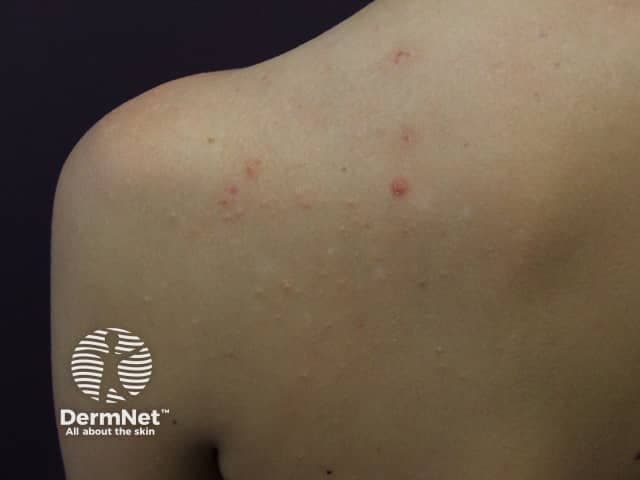 Clinical photography of the upper back and left shoulder/scapular region illustrating a mild inflammatory dermatosis. Modality: clinical photography; perspective: posterior dorsal view. The skin shows multiple small erythematous papules, several with central pustules, clustered along the upper thoracic/scapular zone. Lesions measure approximately 2–4 mm in diameter and are discrete but in close proximity, consistent with a follicular pattern. No significant crusting or scarring is evident; surrounding skin is otherwise uninvolved. The appearance is suggestive of an acneiform eruption or folliculitis, with inflammatory insult centered on hair follicles. Differential diagnoses include acne vulgaris of the back (bacne), folliculitis (bacterial or fungal), keratosis pilaris-like follicular papules, insect bites, or contact dermatitis. The lesions' symmetry and distribution favor follicular inflammation in regions with higher sebaceous gland density and tolerated occlusion. Clinically, this presentation may respond to topical anti-inflammatory agents, benzoyl peroxide, or topical retinoids if cosmetic concerns persist; antibiotic therapy may be considered for secondary infection. Correlation with patient history (pubertal status, hormonal fluctuations, sweating, clothing friction, recent hygiene products) and possible Gram stain or culture if lesions enlarge or fail to improve can guide management. This image highlights common back acne patterns and serves educational purposes for recognition and differential diagnosis. education.