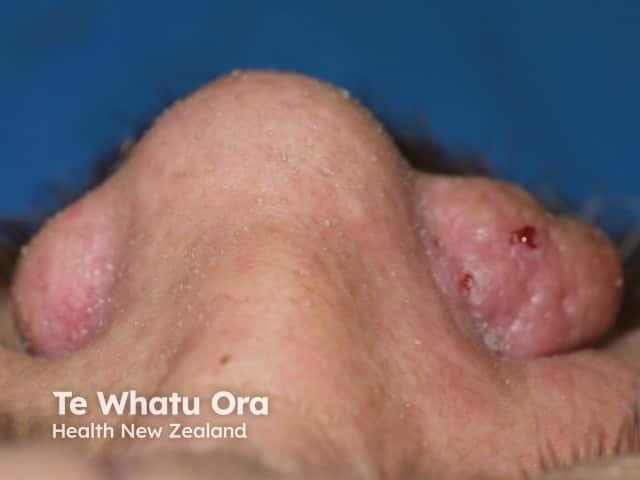 Clinical photography of the nasal and perinasal facial skin in visible light, captured as a close‑up frontal view. The image depicts bilateral perinasal/nasal skin with raised pink to erythematous nodules on the nasal ala and adjacent cheek. Lesions are firm, well circumscribed but with irregular, possibly ulcerated surfaces and focal crusting. The surrounding skin appears mildly scarred and sun‑exposed, consistent with chronic actinic damage. The right nasal lesion shows a slightly larger, rounded dome shaped nodule with an attenuated pearly/pink appearance and subtle surface erosion; the left lesion is smaller and less well defined. No deep tissue involvement is ascertainable from this external view. There is no dermatoscopic detail. The clinical significance is high: new or enlarging cutaneous nodules on the nose region raise suspicion for malignant skin neoplasms such as basal cell carcinoma or squamous cell carcinoma, though benign mimics (sebaceous hyperplasia, keratoacanthoma) are possible. The image is valuable for educational purposes, differential diagnosis discussion, and biopsy planning. Potential clinical use cases include triage in primary care, dermatology assessment, radiology correlation for facial skin cancer staging, and teaching of lesion morphology. This representation aids pattern recognition and correlates with sun‑related skin cancer risk and perinasal oncologic workup and management.