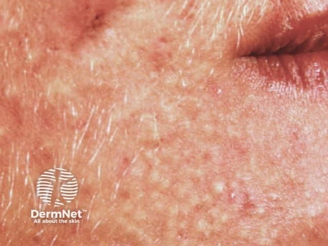 Clinical photograph of adult facial skin showing acne vulgaris. Modality: color digital photography; close-up frontal view of left cheek and perioral region. The skin shows numerous small inflammatory papules and closed comedones within erythematous background. Surface shows rough texture, post-inflammatory hyperpigmentation; no visible pustules or nodules beyond papules; sebaceous prominence; mild focal scarring. The distribution is predominantly in the central to lower cheek and perioral zones; symmetric involvement is suspected though lateralization not certain in this single frame. The visual features correspond to acne vulgaris, predominantly non-inflammatory comedones and mild inflammatory papules; differential includes rosacea (erythema with flushing and telangiectasia), folliculitis, perioral dermatitis. Clinically significant due to risk of scarring if untreated; management typically includes topical retinoids (tretinoin, adapalene), benzoyl peroxide, salicylic acid, topical/oral antibiotics, hormonal therapy in women; isotretinoin in severe cases. This image provides educational reference for adult-onset facial acne assessment, severity grading (milDer-type with comedones and papules), and therapy planning. Notable clinical context: identify pilosebaceous unit involvement, comedone formation, and post-inflammatory hyperpigmentation. Educational value includes recognizing lesion morphology, distinguishing acne from similar mimics, and selecting appropriate imaging-assisted documentation for follow-up, patient education, and clinical trials evaluating novel anti-acne therapies. This supports standardized severity assessment and treatment planning.