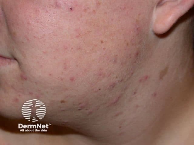 Clinical photography of the left facial skin demonstrates an acneiform eruption involving the left cheek and mandible. Modality: Digital clinical photography; technique: standard unpolarized light, frontal-left oblique perspective capturing the dermal and pilosebaceous units. Anatomical location includes facial skin in the dermal and epidermal compartments with emphasis on the zygomatic and mandibular regions. Visual features: scattered erythematous papules and pustules of varying size scattered across the malar region and jawline, with some small open comedones. Adjacent areas show macular hyperpigmentation consistent with post-inflammatory hyperpigmentation. Skin texture is uneven with mild edema, and there may be shallow scarring or atrophic changes in chronic lesions. Pathophysiology: acne vulgaris affecting pilosebaceous units; inflammation ranges from papular to pustular, with follicular plugging producing comedones. Clinical significance: typical adolescent-to-young-adult acne; differential includes rosacea (erythematous papules, flushing), folliculitis, and keratosis pilaris; imaging not used for diagnosis but this photo is instrumental for clinical assessment and treatment planning. Potential clinical use: educational dermatology resource, baseline documentation for therapy response (topical retinoids, benzoyl peroxide, antibiotics, hormonal therapy as indicated), patient counseling, research on acne severity scoring. This image may aid clarity for students learning acne morphology, helps distinguish inflammatory papules from nodules, and supports standardized lesion counting and grading scales used in clinical trials.