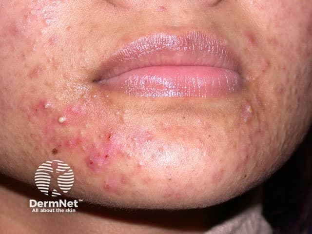 This is a high-resolution clinical photograph of facial skin focusing on the lower face (cheeks, chin) to document acne vulgaris. Modality is clinical photography with macro-detail of the pilosebaceous units. The image captures frontal view of the perioral and mandibular regions with even illumination and natural color balance. Visible findings include multiple erythematous inflammatory papules and pustules scattered across the lower cheeks and chin, with a few comedones (whiteheads) and subtle post-inflammatory hyperpigmentation. Skin surface shows mild textural irregularity, non-scars, and minimal edema around select lesions. The distribution is bilateral and facially symmetric in the lower face, consistent with acne distribution on the jawline and chin. The pattern suggests moderate severity, with inflamed lesions outnumbering comedones and without deep nodules in this field. In a clinical setting, this image would support diagnostic labeling of acne vulgaris, particularly moderate grade, and would be useful for treatment planning, patient education, and response monitoring during topical retinoid/benzoyl peroxide regimens, oral antibiotics, or hormonal therapies if appropriate. Differential considerations include rosacea, folliculitis, and perioral dermatitis, but the predominantly comedone and papulopustular features favor acne. This photograph serves as an educational reference for dermatology trainees and for trials documenting lesion counts and response to therapy.