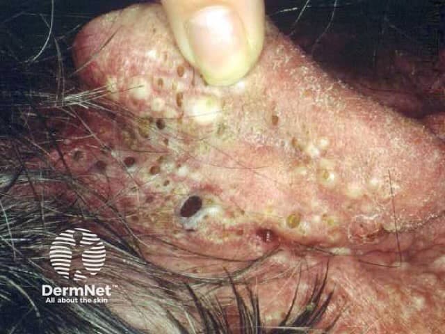 Clinical photograph of the face focusing on pilosebaceous units in the central facial region. This high-magnification close-up reveals multiple open comedones with keratin plugs, several closed comedones, and inflammatory papules and pustules. Deeper nodules or cystic lesions are present, producing a nodular aspect with surrounding erythema and oily, sebaceous-active skin. The distribution is characteristic of acne vulgaris, predominantly involving the cheeks and perioral areas. The image captures a spectrum from noninflammatory comedones to inflammatory and nodulocystic components, reflecting follicular obstruction and sebaceous gland hyperactivity. Clinically, this pattern is associated with acne severity that can lead to scarring if inadequately treated. Differential considerations include folliculitis and rosacea (rosacea less likely given comedones), sebaceous hyperplasia, and keratosis pilaris with follicular involvement. This photo is valuable for dermatology education, patient counseling, and research on acne pathophysiology and treatment response. Potential applications encompass training in recognition of open and closed comedones, assessment of inflammatory burden, and monitoring response to topical therapies (retinoids, benzoyl peroxide) and systemic options (antibiotics, isotretinoin). Additional observations include follicular plugging, surface scale, microcrusting, post-inflammatory hyperpigmentation, and signs of early scarring potential. The close view supports standardized lesion counting and severity grading for clinical trials and educational demonstrations, as well as patient-specific treatment planning and outcome tracking.