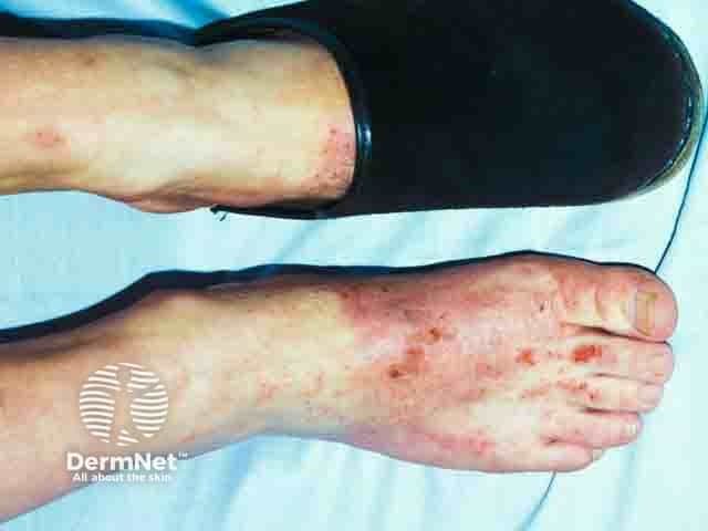 Clinical photography of bilateral feet demonstrating erythematous, vesiculopapular, and crusted dermatitis concentrated where the shoe upper contacts the skin. The dorsum and toes show patchy erythema with adjacent edema, scaling, and excoriations, more pronounced along the medial and dorsal foot margins. The distribution is consistent with a contact irritant/allergic dermatitis pattern influenced by footwear, with a linear to patchy arrangement at the boundary of the shoe. The appearance suggests allergic contact dermatitis to a component of the shoe upper rather than a fungal infection or venous stasis changes. Potential allergens include leather tanning chromates (chromium VI), rubber accelerators, dyes, adhesives, or synthetic polymers used in the upper. Patch testing is recommended to identify the precise allergen; management includes avoidance of the offending material, protective footwear, and skin barrier care. Acute flares respond to topical corticosteroids (e.g., medium-potency to high-potency depending on body area), plus saline or bland emollients and antipruritic measures. Educate patient on product labeling, alternative footwear materials, and routine follow-up to monitor improvement. This image is useful for dermatology training, clinical case discussions, and educational resources on footwear-related dermatitis, allergen exposure, and the value of diagnostic patch testing in suspected allergic contact dermatitis.