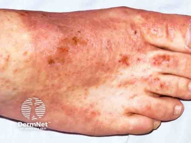 This clinical dermatology photograph depicts the dorsal aspect of the foot with evidence of allergic contact dermatitis consistent with chromate exposure from leather shoe uppers. The image highlights erythematous, pruritic plaques distributed over the dorsum of the foot and between toes, with fine scale, crusting, and secondary fissuring in some regions. The changes are most pronounced along the shoe-closure margins and toe web spaces, where direct skin contact with chromate-containing leather is likely. Inset details include diffuse edema, multiple coalescent patches, and a variable pigmentary change that may reflect postinflammatory hyperpigmentation. This presentation aligns with chromium allergy, a common cause of delayed-type hypersensitivity dermatitis in patients wearing leather footwear; hexavalent chromium (Cr(VI)) is used in leather tanning and can transfer to the skin. Differential diagnoses include irritant dermatitis, atopic dermatitis, and fungal infection such as tinea pedis, but the discrete distribution to footwear contact supports an occupational or recreational exposure history. Diagnostic significance emphasizes the importance of patch testing to confirm chromium sensitivity and to guide avoidance strategies. Clinically, management focuses on topical corticosteroids, barrier protection, and chromium-free footwear, with avoidance of leather with chromate pretreatment. Patch test results would refine future shoe choices and prevent recurrence.