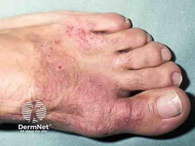 Clinical photograph of the dorsal aspect of the foot demonstrating an acute to subacute eczematous eruption with erythema, vesiculation, and surrounding scale and excoriations, highly suggestive of an allergic contact dermatitis to a shoe upper constituent. The lesions are localized to the dorsum and toe regions, with mild edema and moist, crusted patches adjacent to interdigital spaces. This imaging modality, clinical photography, provides a color-accurate representation of cutaneous inflammation without invasive procedures. Anatomic involvement includes the skin of the foot (epidermis and superficial dermis) in the dorsal surface and toe webs, consistent with a contact-related dermatitis pattern rather than a diffuse systemic eruption. Pathognomonic features are difficult to confirm radiographically; the clinical morphology points toward an allergen exposure, particularly footwear materials such as leather dyes, chromium salts, rubber accelerators, adhesives, or finishing agents. Diagnostic significance lies in supporting a diagnosis of allergic contact dermatitis and guiding allergen identification via patch testing. Differential considerations include irritant contact dermatitis from footwear, tinea pedis, dyshidrotic eczema, psoriasis, and candidal intertrigo in web spaces. Clinical correlation should focus on recent shoe purchases or changes, in-use footwear, and exposure history; management includes allergen avoidance, topical corticosteroids, emollients, and follow-up; education on prevention is essential for optimal outcomes.