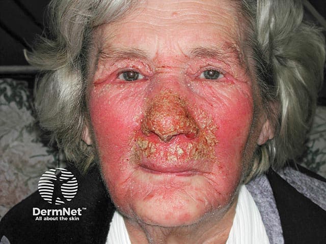 Clinical photograph illustrating allergic contact dermatitis of the face with prominent perinasal crusting and erythema following use of a nasal ointment containing chlorhexidine and neomycin. Modality is standard digital skin photography, frontal/anterior view, with close-up emphasis on the nasal bridge, alae, cheeks, and perinasal folds. The integumentary reaction is manifested by diffuse erythema, edema, excoriation, and bilateral crusted plaques around the nares and nasal tip, extending onto adjacent malar regions. The appearance is consistent with type IV hypersensitivity to topical antiseptics and antibiotic components, producing spongiotic dermatitis with inflammatory cell infiltrates in histology if biopsy were pursued. Clinically, the pattern suggests an allergic contact dermatitis rather than irritant dermatitis due to the localized, well-demarcated distribution and the presence of crusts rather than diffuse burning. Diagnostic significance includes the need to identify and discontinue the offending agent, implement patch testing for chlorhexidine and neomycin, and initiate topical corticosteroids with emollients to accelerate resolution while preventing secondary infection. Potential clinical use cases include dermatology teaching, allergology evaluation, patch-testing workflow, pharmacovigilance of topical agents, and documentation for medicolegal or clinical care pathways. This image is valuable for recognizing perinasal dermatitis and educating about contact allergen avoidance strategies.
