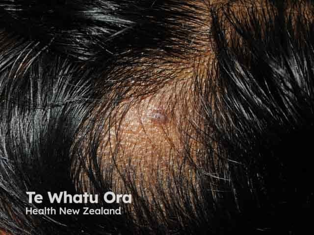 This image depicts a dermatologic clinical photograph of alopecia areata involving the lateral scalp. Imaging modality: clinical photography with macro close-up view of scalp skin and hair follicles, captured without illumination modifiers or contrast. The primary subject is a localized alopecic patch on the lateral scalp, best described as a round to oval, well-demarcated area of hair loss. The overlying skin appears normal in texture, with preserved epidermis and minor surface desquamation or perifollicular subtle erythema not readily observable in non-dermoscopic photography. Hair density within the patch is markedly reduced with visible expansion of follicular openings at the border and intact surrounding hair. The lesion is non-scarring, with no obvious scarring plaques or scarring tracts; there is no evidence of ornamentation or scaly scale. This presentation is characteristic of alopecia areata, a non-scarring autoimmune condition associated with peribulbar lymphocytic infiltrates histologically. Clinically significant for differential diagnosis against tinea capitis, traction alopecia, androgenetic alopecia, and lichen planopilaris. This image is valuable for education, tele-dermatology, and case repositories, enabling recognition of patchy alopecia patterns, conferral of prognosis, and assessment of treatment response to topical or intralesional corticosteroids and immunomodulatory therapies. Useful in training, patient counseling, and multi-disciplinary discussion.