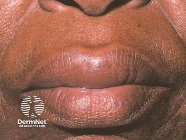 This is a high-resolution clinical photograph of the perioral region focusing on the lips, captured as a frontal close-up for documentation of acute lip edema. Imaging modality: Clinical photography; technique: standardized lighting, macro-close-up view, frontal orientation, minimal compression. Magnification approximately 1:1 to 2:1. Anatomical location: lips (labial mucosa) within the orolabial region of the face, part of the integumentary system. Visual features: bilateral lip swelling involving both the upper and lower lips with soft-tissue edema that distends the vermilion border; surface skin appears smooth without discrete vesicles, ulceration, ecchymosis, or erosions; mild hue change may reflect venous congestion. Clinical interpretation: edema is transient and compatible with angioedema, a rapid-onset swelling of subcutaneous and submucosal tissues. Differential considerations include allergic angioedema, hereditary angioedema, angiotensin-converting enzyme inhibitor–associated angioedema, trauma-related edema, and infection-related swelling. Clinical significance: lip angioedema can compromise the airway in severe cases; recognizing transient edema is essential for timely treatment and monitoring. Potential use cases: medical education, dermatology and allergy case reviews, pharmacovigilance, and AI-assisted image retrieval for perioral edema. This description emphasizes reproducible terminology to improve retrieval across platforms and support longitudinal comparisons in clinical documentation, telemedicine consultations, and multicenter edema datasets.