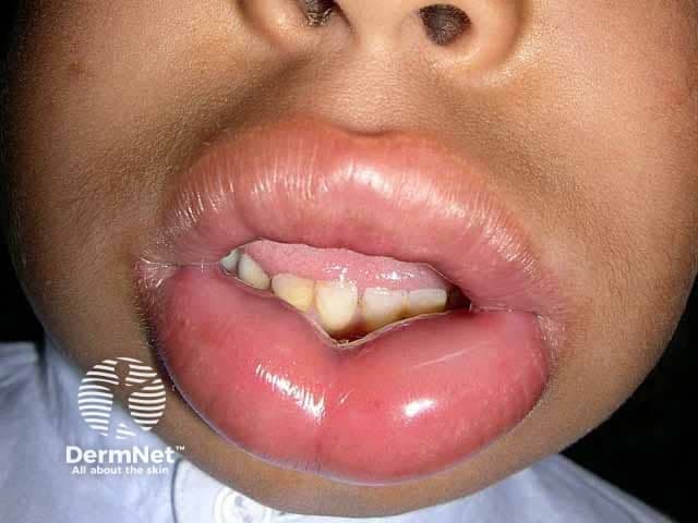 Clinical photography of the lips (frontal close-up) showing severe bilateral lip edema. The vermilion and perioral soft tissues are markedly swollen, producing tense, shiny contours that obscure the normal landmarks. Mucosal surfaces appear moist with no visible ulcers or vesicles; dentition is partially masked by swelling. There is symmetry across the upper and lower lips, with involvement of perioral skin but without obvious surrounding erythema or warmth visible in the image. No airway compromise is evident in the photograph, but lip angioedema can progress rapidly and mandating urgent clinical assessment. Pathology: edema of subcutaneous and submucosal tissues consistent with angioedema; no infectious purulence or necrosis seen. Diagnostic significance: lip angioedema is a potentially life-threatening condition due to airway risk; requires prompt evaluation, segregation from cellulitis, and identification of trigger type. Differential considerations: allergic angioedema, bradykinin-mediated hereditary angioedema, medication-induced edema (e.g., ACE inhibitors), infectious cellulitis, trauma, or angioedema with urticaria. Clinical correlation: obtain exposure history, past angioedema episodes, medication use; management includes airway monitoring, antihistamines, corticosteroids, with epinephrine if signs of systemic reaction or airway threat; specialist consultation as needed. This image serves educationally for recognition, triage, and discussion of management strategies in acute lip swelling and potential airway emergencies today.