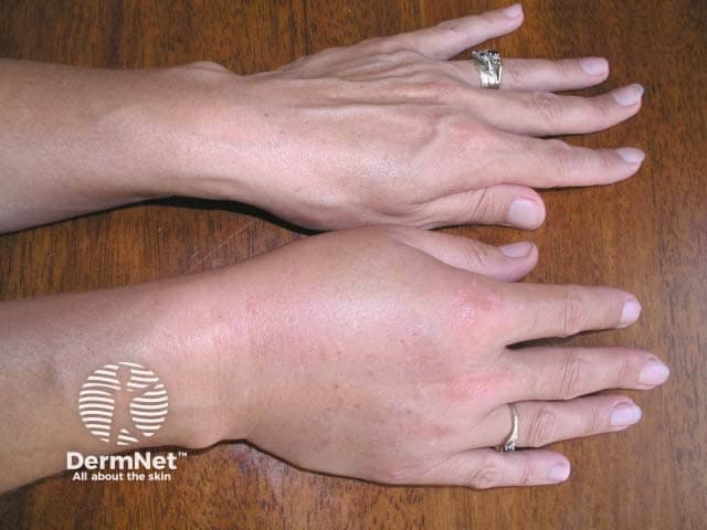 Clinical photography of the right hand illustrating acute soft-tissue edema consistent with angioedema. The dorsal and palmar aspects are swollen, with diffuse subcutaneous swelling around the digits and dorsum of the hand, mild to moderate erythema, and no discrete abscess, bullae, or skin necrosis. Visualized joints maintain normal alignment and there is no focal crepitus. The edema predominantly involves the palmar digits and dorsum, extending to the proximal interphalangeal joints while preserving skin folds and extensor surfaces. The appearance favors a vascular permeability–driven process rather than infectious cellulitis, though secondary inflammation cannot be excluded. In this context, clinical correlation with exposure history, recent medication use (notably ACE inhibitors or similar triggers), trauma, allergen exposure, or hereditary angioedema is essential. The image serves as a documentation tool for acute swelling, guiding differential diagnosis between angioedema, cellulitis, contact dermatitis, and other edematous conditions. It is useful for bedside assessment, patient education, and monitoring response to therapy (antihistamines, corticosteroids, epinephrine if indicated). This visual record supports triage decisions, risk stratification for airway compromise, and educational purposes for clinicians, residents, and students reviewing hand edema etiologies and radiology-lacking diagnostic clues in soft tissue swelling. The image thereby enhances recognition and comparative follow-up imaging decisions.