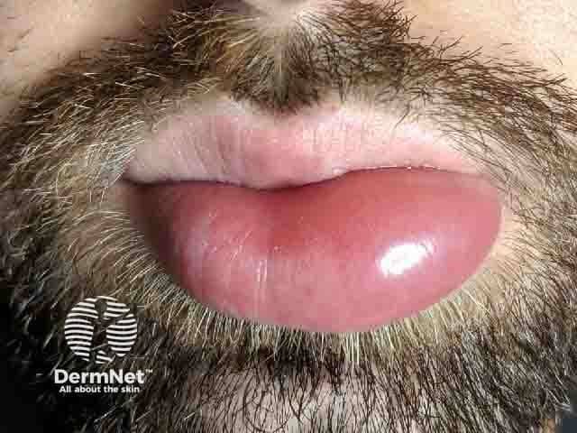Imaging modality: Clinical photograph; technique: high-resolution frontal close-up; view: frontal view of the perioral region focusing on the lips. Anatomical location: lower lip prominence with surrounding mucosal lip tissue; context: soft tissue edema consistent with angioedema of the lips. Visual features: bright pink-red, smooth, expanded lip contour; surface unbroken with no ulceration; turgor and elasticity reduced due to edema; perioral skin shows fine hairs present, no purpura, no vesiculation; the chin and surrounding beard are visible, providing scale. Pathology: edema of the subcutaneous tissue without overt dermal necrosis; non-pitting, non-inflammatory swelling. Diagnostic significance: supportive of acute angioedema; helps differentiate from cellulitis (more erythema, warmth, induration) and allergic dermatitis (more surface involvement). Clinical correlation: correlate with onset, exposure to allergens/ACE inhibitors; assess airway risk if swelling progresses; monitor for tongue or laryngeal involvement; required management may include antihistamines, corticosteroids, or epinephrine in an anaphylactic scenario; potential uses: educational reference for dermatology, emergency medicine, allergology, and primary care; differential diagnoses include hereditary angioedema, medication-induced edema, infectious edema; imaging is not required for routine angioedema but clinical photography documents severity and treatment response. This image is suitable for case-based teaching, triage decision-making, patient education on recognizing lip swelling and seeking prompt medical care.