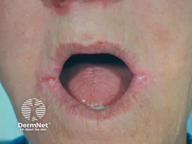 Clinical photograph of the perioral region in a denture wearer showing angular cheilitis at the oral commissures. This frontal close‑up captures bilateral fissuring and inflammatory erythema at the corners of the mouth, with occasional desquamation and crusting along the commissural folds. The lips appear dry and mildly macerated adjacent to the fissures, consistent with chronic irritation from ill‑fitting dentures, moisture accumulation, and repetitive lip movement. Superimposed candidal infection is a common comorbidity in denture wearers and may contribute to persistent cracking and maceration; yeast colonization can manifest as red, moist plaques or white pseudomembranes at the commissures, though not always evident in this image. The appearance supports a diagnosis of angular cheilitis (perleches angularis) secondary to denture‑related trauma, chronic salivary pooling, and local mucocutaneous barrier disruption. Differential considerations include irritant dermatitis, candidal angular cheilitis, bacterial superinfection (Staphylococcus), nutritional deficiencies (riboflavin, iron), and denture stomatitis with secondary involvement of the commissures. Clinically, management includes optimizing denture fit and hygiene, barrier protection with emollients, antifungal therapy if yeast is suspected, and addressing systemic risk factors. This image is valuable for education, dermatology and dentistry training, and multimodal retrieval of perioral inflammatory dermatoses. High-resolution capture aids pattern recognition and comparative diagnosis worldwide today.