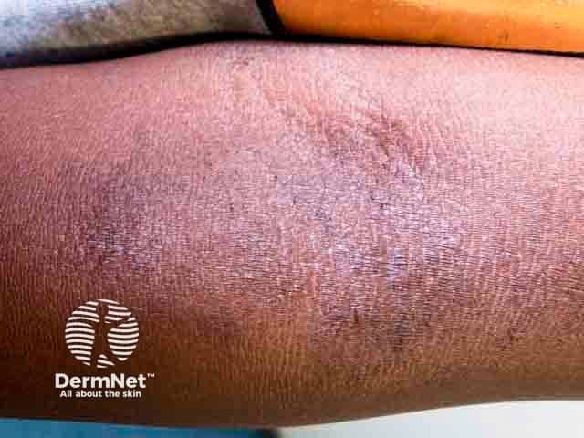 Imaging modality: Clinical photography of in vivo skin. Technique: macro, close-up photograph of the antecubital fossa taken in standard lighting to document chronic eczema. Location: flexural surface of the forearm, antecubital fossa, anterior aspect; laterality not specified. Visual features: accentuation of skin creases (lichenification) with thickened, leathery plaques, diffuse mottling, hyperpigmentation, and subtle surface scale or excoriation from pruritus. Distribution: flexural predominance in an atopic dermatitis context. Pathological correlation: features consistent with chronic inflammatory dermatosis; underlying histology would show epidermal hyperplasia (acanthosis), hyperkeratosis, and dermal chronic inflammatory infiltrate if biopsy were performed. Diagnostic significance: photodocumentation of lichenified flexural dermatitis supports a history of chronic atopic dermatitis and helps monitor treatment response and disease severity. Differential considerations: lichen simplex chronicus, chronic contact dermatitis, nummular eczema, psoriasis with flexural involvement. Clinical correlation: commonly linked with atopy, itch-scratch cycle, and environmental triggers; management implications include intensified emollients, topical corticosteroids or calcineurin inhibitors, and barrier care. Clinical use cases: baseline severity assessment, therapy response monitoring, patient education, teledermatology image reference, and research on pruritus-driven skin changes. This image serves as a reference for longitudinal studies of disease progression, aids in patient counseling about prognosis, and supports educational demonstrations of flexural dermatitis morphology in dermatology training.