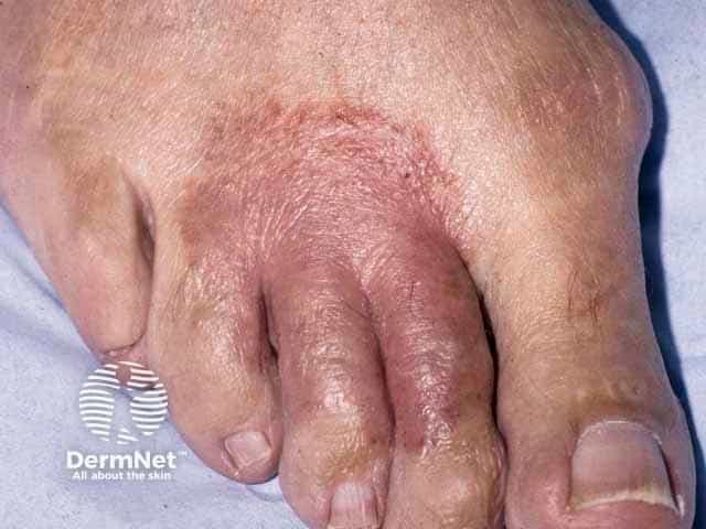 This is a high-resolution clinical photograph of the dorsal aspect of the foot in a patient with a suspected atopic dermatitis presenting as erythematous, dry, and scaly plaques. Visible features include xerosis of the dorsal skin, mild edema, and fissuring around the toe bases with subtle lichenification on chronic lesions. The distribution appears localized to the dorsum of the foot with interdigital involvement; there is no obvious vesiculation. The image emphasizes the differential diagnostic challenge of eczema versus fungal infection, specifically tinea pedis, which can mimic or coexist with atopic dermatitis in the toes and interdigital spaces. For diagnostic workup, clinicians should consider noninvasive tests such as potassium hydroxide (KOH) preparation and fungal culture, and refer for PAS staining or biopsy if atypical features persist. Clinically, adult atopic dermatitis manifests with pruritus, chronic relapsing inflammation, thickened plaques (lichenification), and variable erythema, which may respond to emollients and topical anti-inflammatory therapy. The photograph is valuable for dermatology education, clinical decision support, and research into foot dermatoses, aiding pattern recognition of dorsal-foot eczema versus dermatophytosis, documenting baseline morphology, monitoring therapeutic response, and teaching differential diagnosis. In summary, the image depicts classic eczema features while underscoring the essential step of excluding fungal etiology to guide treatment.