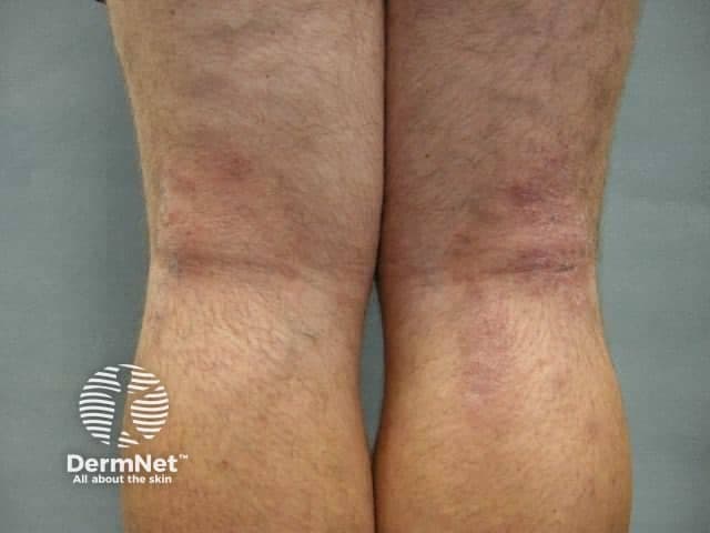 This clinical photograph depicts chronic eczematous changes consistent with atopic dermatitis affecting the bilateral lower legs. Acquired with standard color-calibrated dermatology photography (clinical photography), the image shows low-magnification frontal views of the flexural surfaces around the knees and ankles. The skin is dry (xerosis) with diffuse erythema and pronounced lichenification characterized by thickened plaques with accentuated vertical and horizontal wrinkling. Plaques display scaling and subtle fissuring within creases, and there is episodic excoriation from pruritus. The distribution is bilateral and symmetric, with accentuation in flexural regions and relative sparing of extensor surfaces. The surrounding skin shows mottled hyperpigmentation and mild edema. These features reflect a chronic inflammatory dermatosis with pruritic dominance, often linked to personal or family atopy. Clinically, this pattern supports the diagnosis of atopic dermatitis, versus differential diagnoses such as contact dermatitis, asteatotic eczema, nummular eczema, or psoriasis in atypical locations. Recognizing lichenification, xerosis, and cycled flares is essential for guiding treatment, including regular emollients, barrier repair, topical corticosteroids, calcineurin inhibitors, and anti-pruritic strategies. The image serves educational and diagnostic use for dermatology trainees and researchers studying chronic eczema phenotype, disease severity, and response to therapy. This image enables comparative analysis across eczema severities and informs treatment planning.