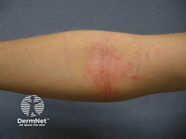 This is a clinical dermatology photograph of a forearm, capturing a close-up view of suspected atopic dermatitis (eczema). Modality: clinical photography; imaging technique: standard color photography; surface skin lesion. Anatomically, the image shows the anterior aspect of the forearm (antebrachial region) with integumentary changes. The skin exhibits erythematous patches with mild scale and subtle edema, following linear and patchy distributions along the forearm. There may be faint superficial fissuring or skin cracking in the flexural areas, and some areas appear slightly lichenified due to chronic scratching. The surrounding skin is otherwise normal in tone. These findings are compatible with atopic dermatitis, including the hallmark features of erythema, scaling, and potential lichenification resulting from chronic scratching. Notable differential considerations include irritant or contact dermatitis, nummular eczema, psoriasis, seborrheic dermatitis, or other inflammatory dermatoses; clinical history and distribution help narrow the diagnosis. The diagnostic significance is that this image demonstrates typical eczema morphology: diffuse or regional erythematous plaques, pruritus, and chronicity. This photo is suitable for educational use in dermatology training, primary care assessment, and teledermatology, aiding recognition of acute and chronic atopic dermatitis, disease severity assessment, and treatment monitoring. Clinically correlates with pruritic history and chronic relapsing disease burden in practice.
