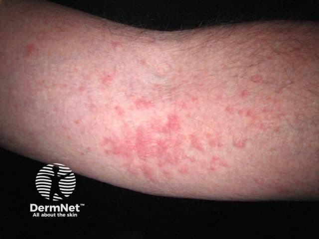 This dermatologic clinical photograph depicts an erythematous, ill-defined patchy to diffuse eruption on the antebrachial forearm consistent with atopic dermatitis (eczema). Acquired with a standard digital camera in close-up view of the skin surface under ambient lighting, it shows diffuse erythema, mild edema, and fine scaling with subtle lichenification in chronic areas. The distribution is localized to the forearm, with no clear involvement of mucosa or nails in this image. The superficial skin changes reflect dermatitis rather than infectious lesions; however, itching and chronic scratching are commonly reported. In epidermal pathology, atopic dermatitis corresponds to spongiotic dermatitis with perivascular lymphocytic infiltrate and potential epidermal hyperplasia in chronic lesions; that histopathology is not directly visible here. Clinically, this image supports diagnosis in the appropriate patient history of pruritus and atopy. Diagnostic significance includes distinguishing eczema from contact dermatitis and psoriasis. Differential considerations include irritant contact dermatitis, allergic contact dermatitis, seborrheic dermatitis, tinea corporis, and nummular eczema. Noting xerosis and barrier dysfunction, management implications involve emollient therapy, topical corticosteroids, and avoidance of irritants. This image is useful for educational demonstrations of typical dermatologic presentations and for image-based search queries related to atopic dermatitis.
