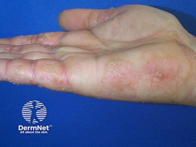 Imaging modality: Clinical photography of the hand. This high-resolution close-up image documents cutaneous changes on the palmar surfaces and digits of a hand, captured from the palmar (volar) aspect. The primary subject is atopic hand eczema (atopic dermatitis affecting the hands), evidenced by xerosis with rough, scaly patches, erythema, and episodic fissuring along the finger creases and interdigital spaces. The skin appears inflamed with mild edema and uniform pink to erythematous coloration in affected areas, while adjacent nonlesional skin remains comparatively normal. The distribution is patchy yet symmetric across involved digits, with involvement of the palmar skin and proximal interdigital folds. The image lacks cross-sectional tissue or histology, so all interpretation is clinically oriented: dermatitis rather than infection, psoriasis, or drug eruption. The visual pattern is characteristic of chronic, atopic-type dermatitis with a tendency toward lichenification with ongoing scratching in exposed areas. Notable diagnostic significance includes identification of hand-specific eczema that complicates daily activities, occupational exposure, and skin barrier dysfunction. This image can support differential diagnosis between atopic dermatitis and irritant/contact dermatitis, guide topical corticosteroid or calcineurin inhibitor therapy, and monitor treatment response. Clinically, correlate with pruritus history, eczema flares, personal or family atopy, and history of irritant exposure. Today.