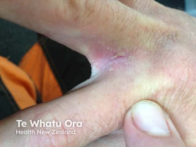 This is a clinical photography image focused on the interdigital web space of the hand, captured using standard digital photography, representing a dermatologic dermatitis in an atopic individual. Modality: Clinical photography; View: close-up interdigital and palmar skin, typically between the fingers, highlighting the first dorsal interosseous and web space. Location: skin of the hand, interdigital fold, palmar aspect; tissue involved: epidermis, with superficial dermal changes. Visual findings: erythematous to violaceous plaques with mild edema, silvery or yellowish scale, fissuring, and subtle maceration in the interdigital clefts; surrounding skin shows dryness and hyperemia. Pattern: localized, symmetric or unilateral involvement of the interdigital spaces, commonly the web spaces between digits 2 and 3 or 3 and 4 in atopic dermatitis. Pathology correlation: clinical diagnosis of eczematous dermatitis (interdigital eczema) in an atopic person; differential includes tinea manuum, allergic contact dermatitis, irritant dermatitis, dyshidrotic eczema. Diagnostic significance: supports atopic dermatitis–associated hand dermatitis; aids in monitoring response to emollients, topical corticosteroids, calcineurin inhibitors, and avoidance of irritants. Clinical utility: educational reference for dermatology trainees, clinicians assessing chronic hand dermatitis, and researchers studying atopic skin disease phenotypes; consider fungal and contact dermatitis testing where indicated. Correlation with patient history and targeted testing strengthens diagnostic accuracy.