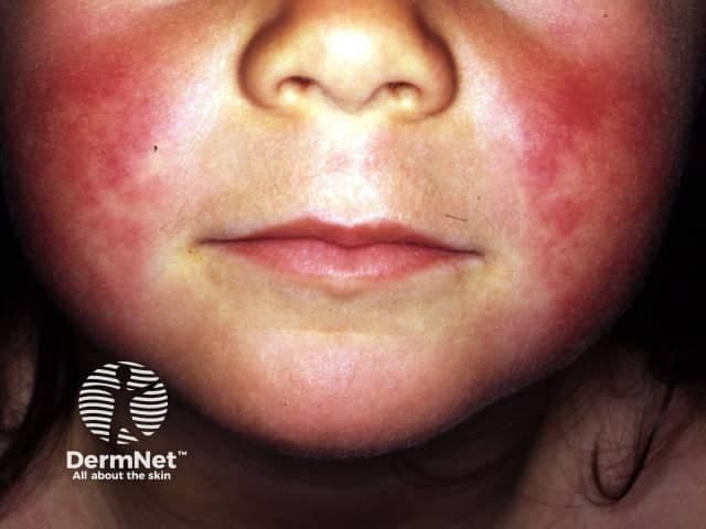 Imaging modality: Digital clinical photography of a pediatric patient's face in a frontal/anterior view. Primary subject: facial dermal eruption consistent with scarlet fever, characterized by symmetric erythematous, sandpaper-like papules on the malar cheeks with accentuation of the perioral region and circumoral pallor. The texture appears rough to the touch, with diffuse superficial vascular erythema and fine desquamation in the acute phase. The nasolabial folds are relatively spared or less reddened, a classic feature in forehead and cheek involvement. The perioral pallor contrasts with surrounding erythema, creating a striking border around the mouth. The image documents cutaneous manifestations of a systemic streptococcal infection, emphasizing the dermatologic hallmark of scarlet fever rather than a primary dermatitis. From a clinical imaging standpoint, this photograph provides documentation of rash distribution, morphology, and texture, enabling visual differentiation from other childhood exanthems such as viral illnesses or drug eruptions. Potential clinical use: bedside diagnosis, medical education, differential diagnosis training, telemedicine triage, and research into rash evolution during antibiotic therapy. Notably, accompanying signs such as fever, pharyngitis, and strawberry tongue would strengthen clinical correlation. The image underscores the value of color-rich dermatologic photography in pediatric infectious disease assessment and patient counseling.