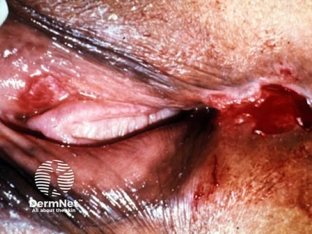 Imaging modality: Clinical photography of the external genitalia. The lesion is a solitary, superficial genital ulcer on perigenital skin with surrounding erythema and a moist, friable base. The ulcer margins are irregular and ragged, with partial undermining and shallow depth. Surrounding tissue appears inflamed and there may be mild edema; crust or exudate can be present at the lesion edge. No visible deep tissue involvement is evident in this surface photograph. The appearance is compatible with an infectious genital ulcer such as chancroid, though herpes simplex and other sexually transmitted infections can present with similar ulcerative lesions. This image emphasizes surface features rather than histology and should be interpreted in the clinical context, including sexual history and concurrent symptoms. Clinically, chancroid typically presents as a painful lesion with soft borders and exudate, often accompanied by tender inguinal lymphadenopathy; differential diagnosis includes syphilitic chancre (painless), genital herpes (painful vesicles), donovanosis, and LGV. The image is valuable for dermatology and infectious disease education, telemedicine assessments, and case-based learning. It aids recognition of external genital ulcers, informs preliminary diagnostic testing (PCR or culture for Haemophilus ducreyi), and supports empiric management decisions in suspected chancroid.
