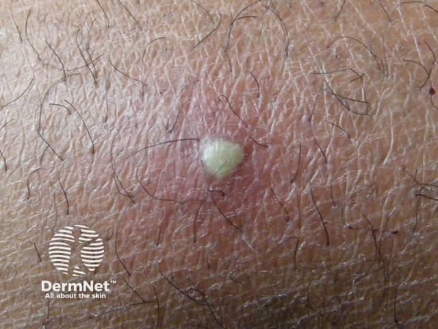 This dermatology clinical photograph documents a solitary boil (furuncle) on the cutaneous surface. Modality: Clinical photography; technique: macro close-up imaging of the skin with standard, noninvasive illumination. The lesion is a dome-shaped, erythematous nodule with a central yellowish-white pustular core representing purulent material within a hair follicle. Surrounding skin shows mild edema and perifollicular erythema. The lesion appears tender on palpation; no drainage is evident although the pus core is visible. The image captures typical signs of acute bacterial folliculitis progressing to furunculosis, most commonly caused by Staphylococcus aureus, with neutrophil-rich inflammatory infiltrate and abscess formation around the follicular unit. Clinically, this finding supports a diagnosis of furuncle rather than a simple acne lesion or epidermal cyst; differential diagnoses include carbuncle, abscess, or inflamed epidermoid cyst. Pathophysiology involves follicular occlusion, microbial colonization, and localized pus accumulation. Management implications include warm compresses, incision and drainage if fluctuance is present, and targeted antibiotics for extensive infection or cellulitis or systemic signs. This image is educational for medical trainees in recognizing cutaneous infections, dermatology case discussions, and demonstrations of localized skin abscesses and follicular infection. Useful for exam prep, clinical decision making, and patient education about boil treatment and outcomes globally.