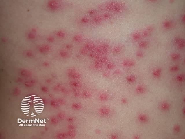 Clinical skin photograph showing numerous small erythematous papules and pustules distributed across trunk/back. The lesions are centered on hair follicles, 2–5 mm in diameter, with surrounding perifollicular erythema and occasional crusting. The overall pattern is diffuse and crops of lesions are evident, consistent with folliculitis. This presentation is classically associated with Pseudomonas aeruginosa infection, often termed hot tub folliculitis, though other gram-negative organisms can cause a similar eruption. Incubation after warm water exposure is typically 24–48 hours. The image demonstrates superficial involvement of the follicular unit without deeper necrosis; no comedones are evident; there is mild edema of the surrounding skin. The phototype appears light to moderate; however, color fidelity is preserved, aiding assessment of vascular dilation and inflammation. Clinically, a history of recent hot tub, pool, or whirlpool exposure should be elicited; pustule cultures or Gram stain can confirm Pseudomonas. Management is usually supportive, with spontaneous resolution in days to weeks; antibiotics with anti-pseudomonal activity are reserved for persistent or extensive disease or immunocompromised patients. These images are suitable for medical education, case repositories, and digital dermatology teaching materials.