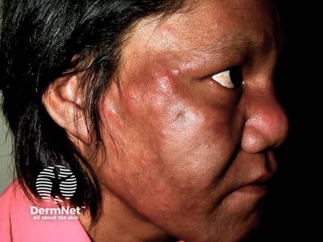 This is a high-resolution clinical photograph of the left lateral midface captured with a standard DSLR camera under color-calibrated lighting, representing dermatology/clinical photography documentation. The left cheek, perinasal region, and periorbital area are the focus, with the ear partially visible for orientation. The patient is in a profile view (sagittal plane) revealing unilateral facial swelling. The image shows acute edema of the facial subcutaneous tissues with diffuse erythema, a shiny taut skin surface, and relative smooth contour despite swelling; there is mild induration but no discrete pustules or vesicles evident. The malar region appears notably puffy, and approximation of the nasolabial fold is altered by edema. The distribution is unilateral, aligning with localized inflammatory or allergic edema, or an early infectious process. Differential diagnoses include facial cellulitis/erysipelas, angioedema, contact dermatitis, and a rosacea-related flare with edema. Diagnostic significance lies in distinguishing infectious versus non-infectious etiologies to determine management: antibiotics for cellulitis, anti-inflammatory measures for inflammatory edema, and consideration of systemic symptoms or fever. Correlate clinically with warmth, tenderness, fever, or creeping spread. This image is relevant for dermatology education, triage in telemedicine, and research on facial edema patterns. Further clinical correlation and systemic evaluation may be required for definitive diagnosis.