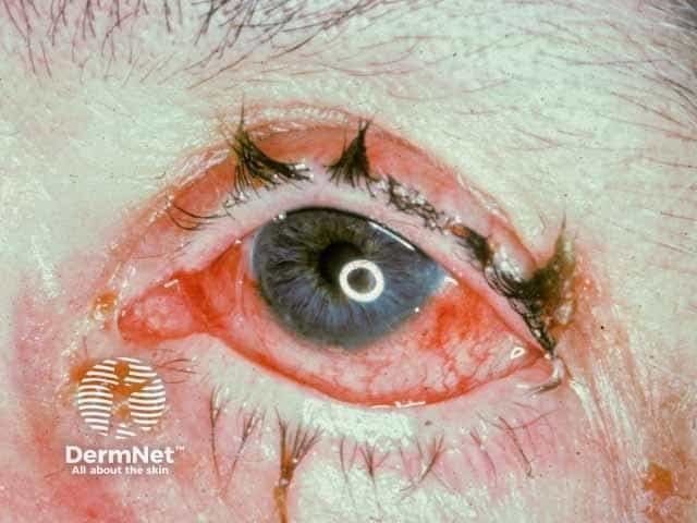 Imaging modality: Slit-lamp anterior segment photography (ophthalmic photography). The image depicts the right/left eye under slit-lamp illumination showing signs of anterior uveitis (iritis) in the setting of Behçet disease. Observed features include diffuse conjunctival injection with hyperemic episcleral vessels and mild edema of the eyelids; the cornea appears clear. The iris is visible with accentuation of the pupil margin and subtle synechiae cannot be excluded. There may be mild circumcorneal flush and anterior chamber reaction not fully resolved in this single color photograph. This pattern is characteristic of inflammatory anterior uveitis commonly seen in Behçet's, often accompanied by photophobia and lacrimation. The ocular surface shows inflammatory signs consistent with active iridocyclitis; the red eye and vascular engorgement reflect intraocular inflammatory activity. Clinically, anterior uveitis in Behçet can precede or accompany systemic flares and carries risk for synechiae formation, glaucoma, and vision loss if inadequately treated. Differential considerations include other etiologies of non-granulomatous anterior uveitis such as HLA-B27-associated uveitis, sarcoidosis, juvenile idiopathic arthritis, herpetic anterior uveitis, or masquerade syndromes. The image supports diagnosis when integrated with clinical history of recurrent oral/genital ulcers and systemic vasculitis. Management implications include prompt ophthalmology referral and escalation to corticosteroids and immunosuppressants as per protocols globally.
