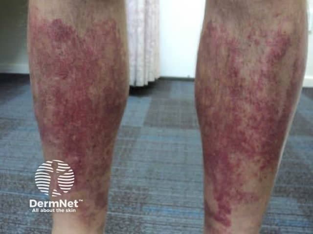 Clinical photography of bilateral lower legs demonstrating pigmented, non-blanching purpuric patches consistent with golfer's capillaritis (pigmented purpuric dermatosis). The image shows the pretibial surfaces of the shins with diffuse reddish-brown to purple macules and patches, irregular borders, and variable intensity, extending from the distal thirds to above the ankles. Superficial pigment deposition (hemosiderin) produces a mottled appearance, with faint residual erythema and mild edema in places. There is no obvious ulceration or vesiculation. The distribution is symmetric and predominantly on exposed areas subjacent to prolonged standing or exercise, a classic clinical pattern for capillaritis. The color progression may range from red to brick-red to brown over weeks, reflecting resolving inflammation and pigmentary changes. Clinically, these findings are characteristic of pigmented purpuric dermatoses, in particular Schamberg-like patterns, and can be exacerbated by venous insufficiency or venous hypertension without systemic involvement. Important differentials include vasculitic purpura, stasis dermatitis, drug-induced purpura, and other pigmented rash disorders. Correlating with history, venous examination, and laboratory studies helps distinguish benign pigmented purpura from inflammatory vasculitides. Management focuses on skin protection, compression therapy, leg elevation, and monitoring for progression; prognosis is generally favorable with recurrence possible. This image serves educational purposes for dermatology and primary care training, teledermatology triage, and dermatosis differential education.