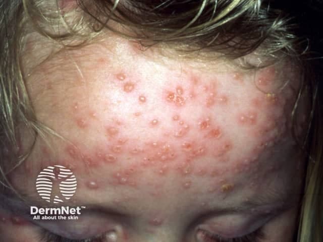 Clinical photography of a pediatric facial skin eruption performed in frontal close-up view. The image documents multiple small vesicular and papular lesions on the forehead with surrounding erythema and several crusted plaques, representing variable disease stages. Findings are characteristic of varicella-zoster virus infection (chickenpox): crops of vesicles and papules at different evolution points, dew-drop on rose petal appearance, superficial epidermal involvement, and mild surface crusting. The distribution is predominantly on the face with potential trunk involvement not shown here; lesions are discretely grouped with some coalescence possible as they crust. This modality captures surface morphology, color change, and lesion configuration to support clinical diagnosis without histology. Pathognomonic clinical features include pruritus, fever, malaise, and contagion potential; differential considerations include disseminated herpes simplex, pityriasis rosea, contact dermatitis, and other vesicular exanthems. Diagnostic significance lies in recognizing crops and stage variability, enabling timely isolation, supportive care, and parental guidance. This image is valuable for dermatology education, pediatrics training, telemedicine triage, and reference in clinical case discussions. Use cases include differential dx practice, image-based teaching, and documentation of characteristic vesicular rash patterns seen in primary varicella. Images of similar presentation aid rapid recognition in clinics, schools, and remote learning platforms worldwide for education.