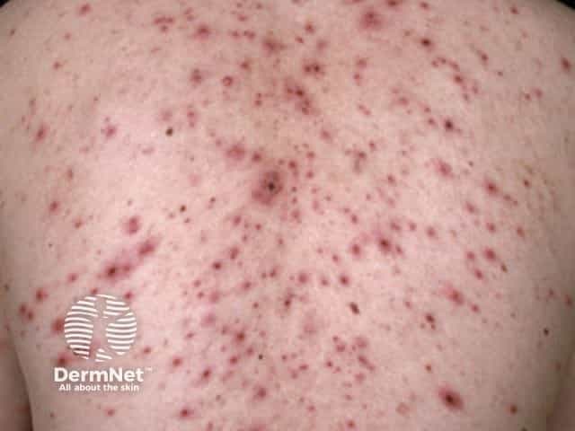 Imaging modality: Clinical photography of an in vivo human back demonstrates a varicella-zoster infection with a classic chickenpox eruption. The posterior trunk shows numerous vesicular and papular lesions on an erythematous base, distributed in crops at different developmental stages from macules and papules to tense vesicles, some becoming crusted. The vesicles often have a dew-drop on a rose petal appearance and are interspersed with non-vesicular papules, producing a mixed morphology pattern. The rash is trunk-predominant with relative sparing of the face in early illness, and lesions are in various evolutionary phases within close proximity. Visual features include clustered, fluid-filled lesions, surrounding erythema, mild edema, and crust formation as vesicles rupture and heal. Clinically, this presentation is highly suggestive of primary varicella-zoster virus infection, with contagiousness until crusts form and fever or malaise commonly accompanying rash. Diagnostic significance rests on lesion morphology, distribution, temporal sequence, and epidemiologic context, distinguishing varicella from herpes zoster, disseminated HSV infection, pityriasis rosea, or dermatitis. Management implications include isolation, supportive care, and consideration of antiviral therapy in children or adults at risk. This image serves educational value for dermatology, infectious diseases, medical students, and clinical documentation. Documentation supports clinical teaching and patient education on contagious spread.