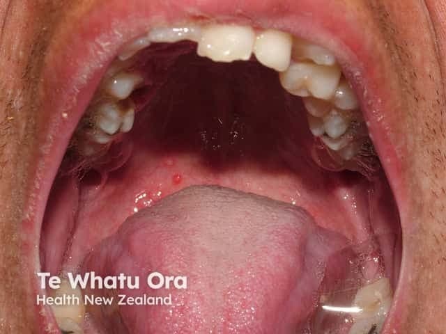Clinical intraoral photograph depicting mucosal enanthem consistent with varicella (chickenpox) involvement of the oral mucosa. Modality: clinical photography of the oral cavity, frontal intraoral view with the mouth opened to expose the buccal mucosa, tongue, hard palate, and gingival tissues. The image highlights multiple vesicular lesions on oral mucosa with erythematous bases, some vesicles partially ruptured forming shallow erosions and irregular ulcers. The lesions appear discrete yet can coalesce in affected areas, reflecting the characteristic varicella presentation of generalized mucocutaneous involvement. The surrounding mucosa is moist and mildly erythematous, with preserved structural integrity of the teeth and adjacent gingiva. No purulent discharge is evident; there is subtle edema of the labial mucosa. This visualization illustrates an enanthem rather than exanthem limited to the skin, emphasizing mucosal involvement that may accompany the cutaneous rash. In clinical practice this pattern supports a varicella diagnosis when integrated with fever, malaise, pruritic vesicular rash, and compatible epidemiologic context. Differential considerations include herpes simplex stomatitis, aphthous ulcers, or hand, foot, and mouth disease; however, age, distribution, and concurrent skin findings aid differentiation. The image is valuable for medical education, dermatology, infectious disease, dental training, and radiology correlate when assessing vesicular mucositis. Useful for case discussions, exams, and remote review.