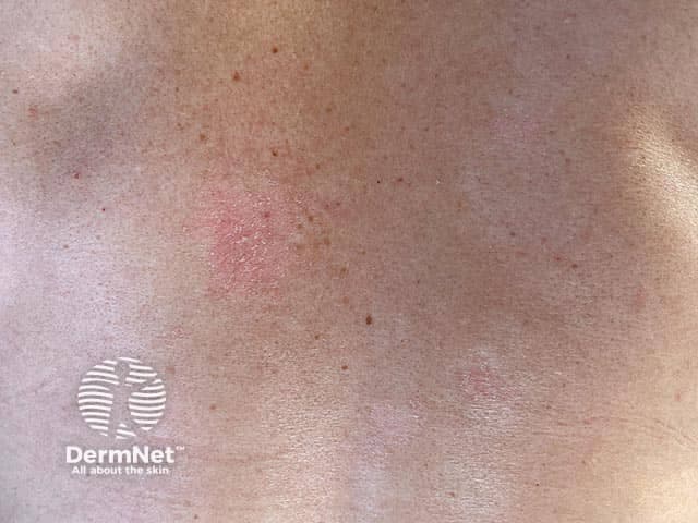 Clinical photography of early superficial plaque psoriasis on the back (posterior trunk). The image depicts well-demarcated, erythematous plaques with overlying loosely adherent silvery scales. On gentle manipulation, the scale becomes more prominent, and scratching accentuates the shedding of scales, compatible with the classic Auspitz phenomenon. The plaques appear epidermal in location, with discrete to coalescing patches centered on the dorsal torso and sparing unaffected skin. The skin surface shows slight hyperkeratosis, mild epidermal thickening (acanthosis), and minimal surrounding edema. There is no purulence or crusting; the lesions are non-ulcerated and without vesiculation. This appearance is characteristic of plaque psoriasis, a chronic, immune-mediated dermatosis with rapid keratinocyte turnover and inflammatory infiltrates. The clinical relevance includes differentiation from eczema and tinea corporis; a dermatitis with silvery scale is more psoriasis-like, whereas eczema typically exhibits lichenification and oozing, and tinea shows ring-like margins with central clearing. The image highlights features important for diagnosis: plaque morphology, scaling pattern, and trunk distribution. In educational and research contexts, this image supports teaching psoriasis pathophysiology, differential diagnosis, and treatment planning, including topical corticosteroids, vitamin D analogs, and phototherapy. Clinically, the finding warrants evaluation for associated comorbidities such as psoriatic arthritis and metabolic syndrome for comprehensive patient care.