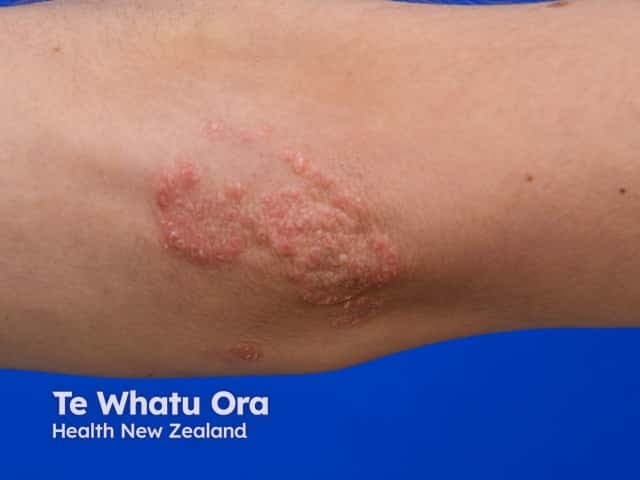 Imaging modality: Clinical photography. This is a high-resolution, close-up surface photograph of an in vivo elbow lesion, focusing on the antecubital region. Primary subject: a chronic plaque psoriasis plaque with a proximal Koebner line after scratching. Anatomical context: cutaneous skin of the elbow (integumentary system; extensor surface). Visual features: well-defined erythematous plaque with adherent silvery scale, thickened hyperkeratosis, slight fissuring at the margins, and a linear, proximal, scratch-induced lesion corresponding to koebnerization. Notable findings: localized psoriasis morphology with coalescent plaques and intact surrounding skin; no ulceration; mild perifollicular changes may be absent. Clinical significance: koebner phenomenon is a diagnostic and prognostic indicator in psoriasis; trauma-induced lesions reflect disease activity and help distinguish psoriasis from other dermatoses. Differential considerations: eczema/atopic dermatitis, tinea corporis, lichen simplex chronicus; clinical correlation: assess for additional plaques at other sites (scalp, knees, elbows), screen for nail/arthritis involvement, tailor therapy accordingly. Potential clinical use cases: educational dermatology resources, patient education on avoiding skin trauma, documentation for treatment response and research into Koebnerization patterns. The image serves as a reference for lesion morphology classification, aids in teaching koebnerization mechanisms, and supports standardized annotation for image-based psoriasis databases. Clinicians may compare longitudinally to monitor therapeutic response and disease activity.