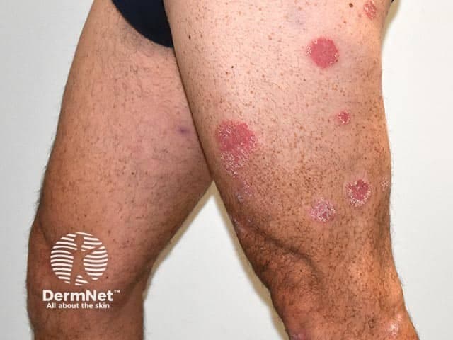 Clinical photography of cutaneous psoriasis on the lower legs, captured as a frontal close-up of extensor surfaces. This dermatologic image depicts multiple well-circumscribed, erythematous plaques with characteristic silvery white scale, distributed on the anterolateral aspects of the shins and extending to surrounding skin. Plaques range from several centimeters in diameter to smaller lesions, with clearly defined borders and a slightly raised, plaque-like morphology. There is mild to moderate surface scaling and partial crusting in several plaques, with surrounding islands of normal-appearing skin. The photograph emphasizes the chronic, relapsing nature of plaque psoriasis, a T-cell mediated, inflammatory dermatosis affecting the integumentary system. The regional localization corresponds to typical extensor surfaces of the limbs; however, lesions may be symmetrical and bilateral. Differential considerations include eczema/atopic dermatitis, tinea corporis, pityriasis rosea, or nummular dermatitis, though the combination of well-demarcated plaques and fine silvery scales strongly supports psoriasis. Clinical relevance: diagnosis is usually clinical, supported by history and, if needed, dermoscopic or histopathologic correlation. This image is useful for educational demonstrations of plaque morphology, treatment monitoring, and illustrative references for dermatology training, telemedicine review, and psoriasis severity assessment in clinical trials. Documented features include scaling pattern, plaque size variability, and potential Koebnerization in susceptible individuals.