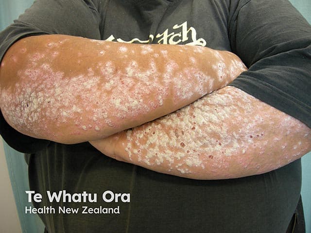 Clinical-wide dermatologic photography of the forearms in anterior view demonstrates extensive plaque psoriasis. Bilateral involvement of extensor surfaces presents as well‑demarcated erythematous plaques with adherent silvery scales, varying in thickness from moderate to dense. The plaques extend from near the elbows distally along the forearms, with areas of mild scaling and fissuring where plaques are thickest. There is no visible pustulation, ulceration, or atrophic change in this image, though surface texture ranges from smooth to raised. The morphological features—plaque morphology, silver-scale coating, and well‑defined borders—are characteristic of psoriasis vulgaris. The photograph captures subjective disease burden, distribution pattern, and surface level pathology, providing a visual record for assessment of extent and severity. Notably, the extensor-dominant distribution helps distinguish psoriasis from other inflammatory dermatoses such as eczema or tinea. This image complements clinical history and examination, enabling trajectory monitoring, treatment response evaluation, and patient education about prognosis and potential comorbidities (e.g., psoriatic arthritis, metabolic syndrome). It supports educational use for trainees and researchers studying plaque psoriasis morphology, distribution on the limbs, and therapeutic outcomes in chronic skin disease. Photographic documentation supports standardized severity scoring, helps track lesion evolution, and facilitates multi-site research collaborations evaluating topical and systemic therapeutic efficacy in diverse populations.