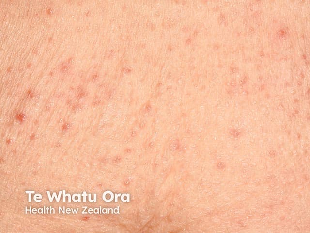 This is a clinical photograph of the dorsal back demonstrating numerous tiny follicular papules consistent with keratosis pilaris–like eruption. The lesions are typically 1–3 mm, skin-colored to pink, with a fine keratotic keratin plug at the follicular ostium. Distribution is diffuse over the thoracic–upper lumbar back, with greater concentration along hair-bearing regions and sparing of the trunk folds. No confluent plaque or significant surface desquamation is evident. The appearance resembles folliculitis but lacks pustulation or obvious infectious inflammation. The presentation is temporally associated with Bruton tyrosine kinase (BTK) inhibitor administration, a class effect previously reported as a follicular keratosis pilaris–like eruption. The image captures an early to mid-stage manifestation; individual lesions show discrete elevation and mild erythema on light-skinned skin. Imaging modality is clinical photography; technique includes close-up, high-resolution digital capture with neutral lighting to preserve true color. Anatomic context: integumentary system; posterior trunk (dorsal back); no deep structure assessment. Clinically, this finding may represent a drug eruption rather than classic keratosis pilaris and should prompt evaluation of therapy continuation, dose modification, or dermatology consultation. Differential diagnoses include keratosis pilaris, idiopathic follicular hyperkeratosis, mild folliculitis, and pityriasis rubra pilaris variants. Histology would show hyperkeratosis and follicular plugging if biopsied, confirmatory.