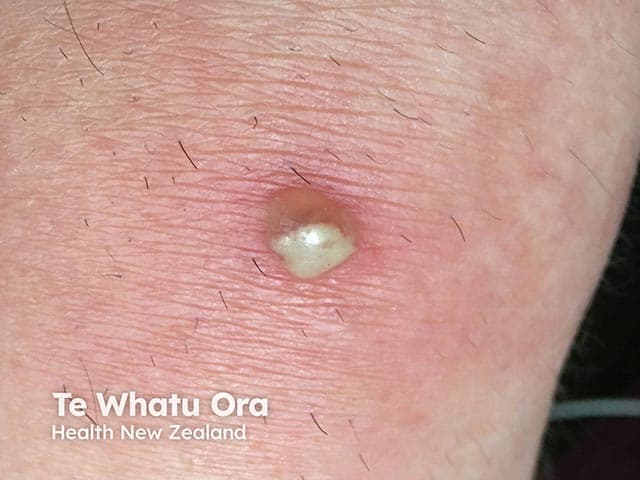 Imaging modality: Clinical photography of a cutaneous lesion. Anatomical location: left forearm skin, superficial dermis and hair follicle involvement. Perspective: close-up, frontal view of a solitary boil. Visual features: round, dome-shaped erythematous plaque with a central pustule and a creamy-white fluctuant core; surrounding perilesional induration; mild surrounding erythema; skin folds visible; no surrounding necrosis. Pathology inference: consistent with furuncle (boil) caused by Staphylococcus aureus infection of a hair follicle with inflammatory abscess formation within the dermis and subcutaneous tissue. In the clinical context, this lesion may arise in patients receiving Bruton tyrosine kinase inhibitors, which can disrupt B-cell function and predispose to bacterial skin infections; however, localization remains cutaneous and localized drainage is often therapeutic. Diagnostic significance: highlights a localized cutaneous infection; differential includes folliculitis, carbuncle, impetigo, abscess; MRSA risk; culture may guide antibiotics. Clinical correlation: correlate with systemic signs (fever, leukocytosis); assess need for wound drainage; versus incision and drainage; consider antibiotic therapy targeting Staphylococcus aureus; review BTK inhibitor therapy with treating oncologist for infection risk mitigation. Potential applications: educational dermatology cases, infection management training, BTK inhibitor adverse effect surveillance, antimicrobial stewardship. Image-guided documentation supports clinical decision-making, antibiotic stewardship, and comparative learning for dermatology and infectious disease education and training.
