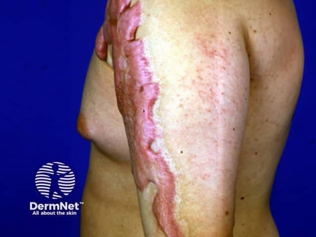 Clinical photography of the left upper extremity showing a long, well-demarcated hypertrophic scar following a burn injury. The scar runs longitudinally along the lateral/posterior aspect of the arm from mid-upper arm to proximal forearm. The scar tissue is raised, firm, and erythematous-pink with a shiny, contracted surface and irregular parallel banding consistent with post-burn scar formation. Surrounding skin shows residual erythema and hypopigmentation with patchy telangiectasia and minor textural changes. No active ulceration is evident. The scar margin is relatively sharp with limited pliability; subtle contour irregularities indicate localized contracture potential that may restrict flexion or extension at the elbow depending on involvement. The image demonstrates typical scar morphology: dense collagenous bundles, altered dermal architecture, and abnormal pigmentation. This type of lesion is common after partial-thickness to full-thickness burns and can contribute to restricted range of motion and cosmetic concerns. Clinically, such scars are evaluated for severity using scales like Vancouver Scar Scale or Patient and Observer Scar Assessment; management options include silicone gel sheeting, pressure therapy, intralesional corticosteroids, laser therapy, and physical therapy. The image is intended for dermatology, burn surgery, and rehabilitative medicine education, illustrating scar characterization, differential diagnosis (hypertrophic vs keloid scar), and therapeutic planning.