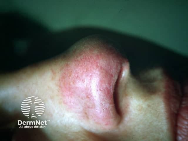 This high-resolution clinical photography shows cutaneous lupus pernio, the characteristic violaceous, indurated plaques of sarcoidosis involving the nasal dorsum and surrounding integument. Acquisition modality: bedside clinical photography, full-face anterior view, with close-up focus on the nose (nasal pyramid, alar rims) to document contour irregularities and color. The lesion appears as erythematous-violaceous plaques with firm, raised induration, subtle scaling, and blending erythema into adjacent normal skin. Dermal granulomatous inflammation in lupus pernio typically yields palpable plaques and nodules; in this image, the lesion is non-ulcerated, symmetric along the nasal region, with mild edema and vascular prominence. In the clinical context, lupus pernio strongly suggests sarcoidosis and often indicates chronic systemic involvement, particularly of the lungs and upper airways; dermatologic findings may precede or accompany pulmonary disease. Differential diagnoses include granulomatous rosacea, tuberculoid granulomatous lesions, and other granulomatous dermatoses; biopsy would show noncaseating granulomas with tight epithelioid granulomas and multinucleated giant cells. This image supports diagnostic correlation, educational case illustration, and differential diagnosis discussion for dermatology, rheumatology, pulmonology, and pathology. It has clinical relevance for prognosis and monitoring response to therapy, including corticosteroids or steroid-sparing agents, and for documenting treatment outcomes. Correlation with biopsy and systemic evaluation remains essential for definitive diagnosis.